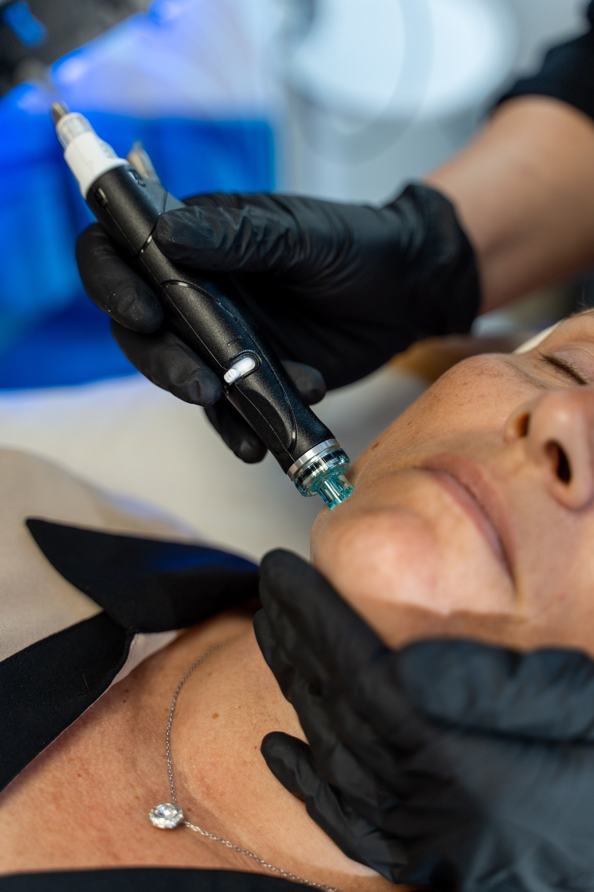 Soin hydrafacial réalisé sur un visage de femme